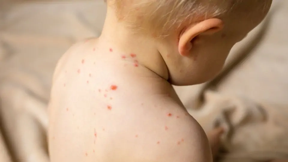 Cilt altı kanama neden olur? Purpura hakkında her şey