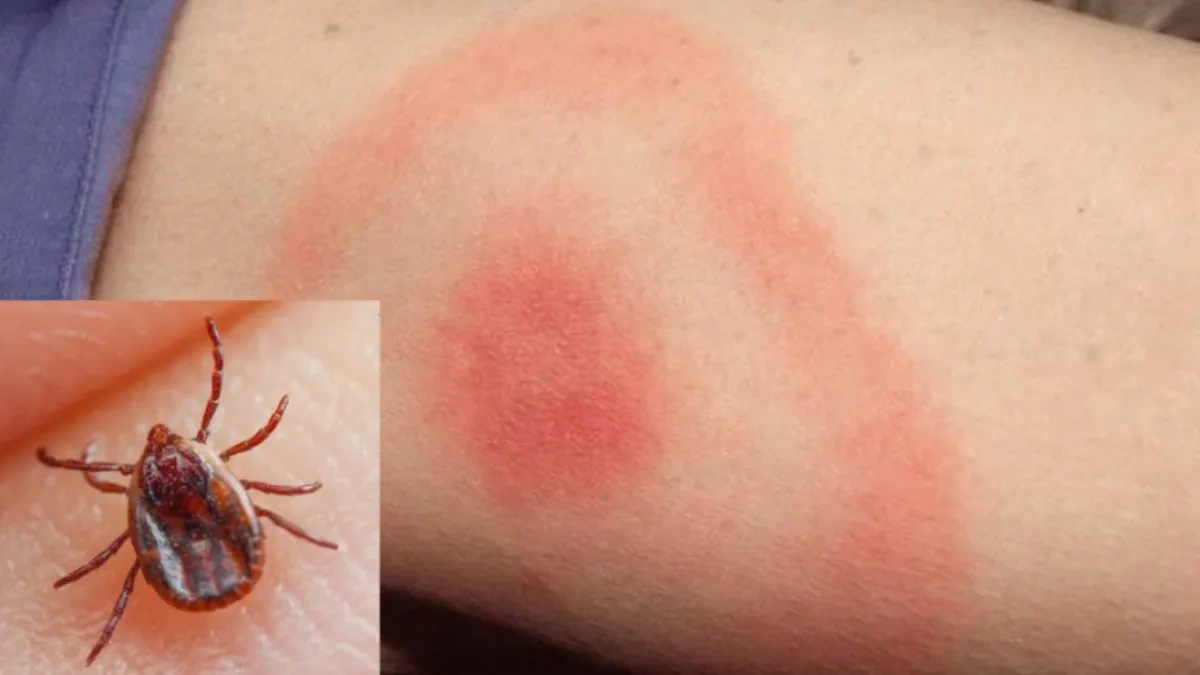 Lyme hastalığı nedir? Belirtileri ve korunma yolları