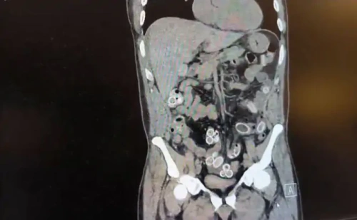 Fas'tan midesinde uyuşturucu getirdi: 49 kapsül esrar çıktı