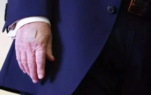 Trump'ın sağ elindeki bandaj merak uyandırdı: Sağlık durumu tartışılıyor