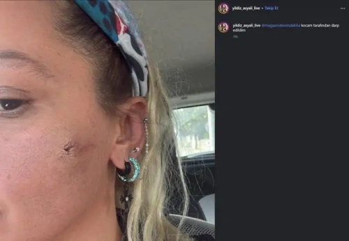 Yıldız Asyalı eşinden şiddet gördüğünü sosyal medyadan duyurdu